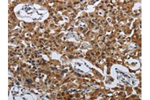 The image on the left is immunohistochemistry of paraffin-embedded Human lung cancer tissue using ABIN7192614(SPAG4 Antibody) at dilution 1/50, on the right is treated with synthetic peptide. (SPAG4 anticorps)