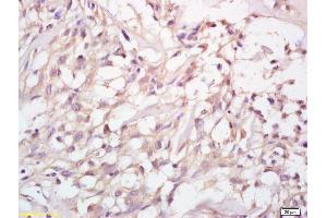 Formalin-fixed and paraffin embedded human cervical carcinoma labeled with Anti-MMP-23 Polyclonal Antibody, Unconjugated (ABIN759176) at 1:200 followed by conjugation to the secondary antibody (Matrix Metallopeptidase 23 (MMP23) (AA 281-380) anticorps)