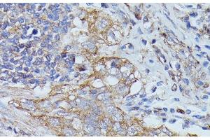 Immunohistochemistry of paraffin-embedded Human lung cancer using CTTN Polyclonal Antibody at dilution of 1:100 (40x lens).