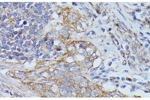 Immunohistochemistry of paraffin-embedded Human lung cancer using CTTN Polyclonal Antibody at dilution of 1:100 (40x lens). (Cortactin anticorps)