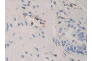 Detection of BMP15 in Human Prostate Tissue using Polyclonal Antibody to Bone Morphogenetic Protein 15 (BMP15)