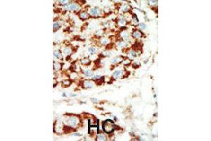 Formalin-fixed and paraffin-embedded human hepatocellular carcinoma tissue reacted with PRKAB1 polyclonal antibody  , which was peroxidase-conjugated to the secondary antibody, followed by AEC staining . (PRKAB1 anticorps  (N-Term))