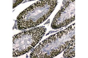 IHC testing of FFPE human colon cancer tissue with UBA2 antibody at 1ug/ml. (UBA2 anticorps)