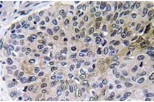 Immunohistochemistry analysis of NGF Antibody in paraffin-embedded human lung carcinoma tissue. (Nerve Growth Factor anticorps)