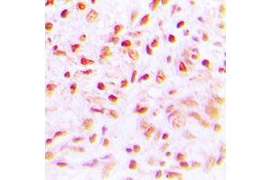 Immunohistochemical analysis of SENP6 staining in human lung cancer formalin fixed paraffin embedded tissue section.