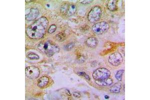 Immunohistochemical analysis of RPL35 staining in human lung cancer formalin fixed paraffin embedded tissue section.