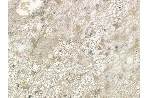 ABIN6257381 and ABIN6273726 at 1/100 staining human astrocytoma by IHC-P. (NDFIP2 anticorps  (Internal Region))