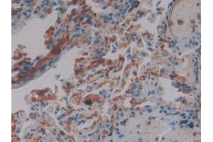 Detection of FGg in Human Lung Tissue using Polyclonal Antibody to Fibrinogen Gamma (FGg)