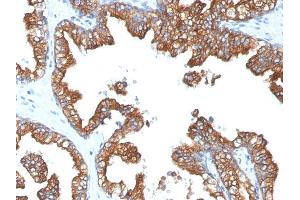Formalin-fixed, paraffin-embedded human Prostate Carcinoma stained with Cytokeratin 8/18 Monoclonal Antibody (5D3). (CK8 & CK18 anticorps)