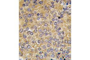 Formalin-fixed and paraffin-embedded human prostata carcinoma tissue reacted with PLAU antibody (N-term), which was peroxidase-conjugated to the secondary antibody, followed by DAB staining.