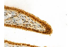 ABIN6261157 and ABIN6266615 at 1/100 staining Human ovarian cancer and adjacent normal tissues by IHC-P. (Cyclin L1 anticorps  (C-Term))