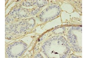 Immunohistochemistry of paraffin-embedded human breast cancer using ABIN7168555 at dilution of 1:100 (SKP2 anticorps  (AA 1-424))