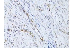 Immunohistochemistry of paraffin-embedded human uterine cancer using SELE Antibody.