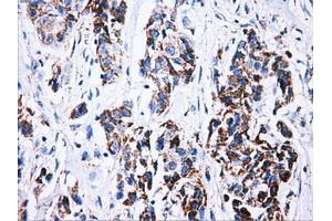 Immunohistochemical staining of paraffin-embedded Carcinoma of liver tissue using anti-ATP5Bmouse monoclonal antibody. (ATP5B anticorps)