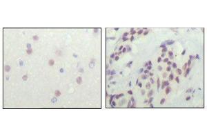 Immunohistochemical analysis of paraffin-embedded human cerebra (left) and breast carcinoma tissue (right), showing nuclear location with DAB staining using NCOR1 mouse mAb. (NCOR1 anticorps  (AA 1-192))