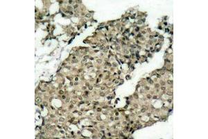 Immunohistochemistry of paraffin-embedded human breast carcinoma using Phospho-G3BP1-S232 antibody (ABIN2988019). (G3BP1 anticorps  (pSer232))