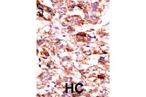 Formalin-fixed and paraffin-embedded human cancer tissue reacted with the primary antibody, which was peroxidase-conjugated to the secondary antibody, followed by AEC staining. (ADCK5 anticorps  (C-Term))