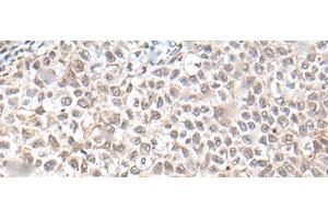 Immunohistochemistry of paraffin-embedded Human ovarian cancer tissue using UBN1 Polyclonal Antibody at dilution of 1:130(x200)