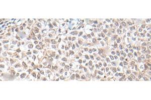 Immunohistochemistry of paraffin-embedded Human ovarian cancer tissue using UBN1 Polyclonal Antibody at dilution of 1:130(x200) (Ubinuclein 1 anticorps)