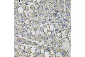 Immunohistochemistry of paraffin-embedded human liver injury using GFPT1 antibody at dilution of 1:100 (x40 lens). (GFPT1 anticorps)