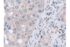 Detection of NID2 in Human Breast cancer Tissue using Polyclonal Antibody to Nidogen 2 (NID2)