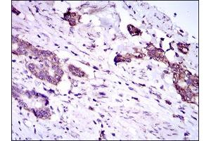 Immunohistochemical analysis of paraffin-embedded esophageal cancer tissues using DNAL4 mouse mAb with DAB staining.