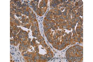 Immunohistochemistry of Human cervical cancer using ADAMTS15 Polyclonal Antibody at dilution of 1:60