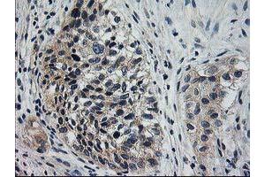 Immunohistochemical staining of paraffin-embedded Carcinoma of Human bladder tissue using anti-XPNPEP3 mouse monoclonal antibody. (XPNPEP3 anticorps)