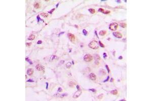 Immunohistochemical analysis of MEF2A (pT319) staining in human lung cancer formalin fixed paraffin embedded tissue section.