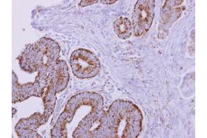 IHC-P Image ACADM antibody detects ACADM protein at mitochondria on human colon carcinoma by immunohistochemical analysis. (Medium-Chain Specific Acyl-CoA Dehydrogenase, Mitochondrial (MCAD) (Center) anticorps)