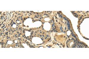 Immunohistochemistry of paraffin-embedded Human thyroid cancer tissue using TRPC4AP Polyclonal Antibody at dilution 1:40 (TRPC4AP anticorps)