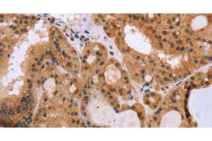 Immunohistochemistry of paraffin-embedded Human thyroid cancer using EPDR1 Polyclonal Antibody at dilution of 1:40 (EPDR1 anticorps)