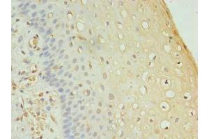 Immunohistochemistry of paraffin-embedded human cervical cancer using ABIN7165402 at dilution of 1:100 (FAM136A anticorps  (AA 2-138))