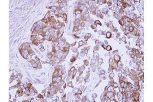 IHC-P Image Immunohistochemical analysis of paraffin-embedded OECM1 xenograft, using Fatty Acid Synthase, antibody at 1:500 dilution. (Fatty Acid Synthase anticorps  (N-Term))