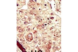 Formalin-fixed and paraffin-embedded human cancer tissue reacted with the primary antibody, which was peroxidase-conjugated to the secondary antibody, followed by DAB staining.