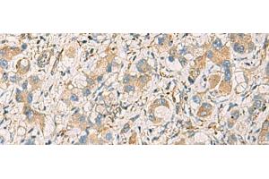 Immunohistochemistry of paraffin-embedded Human liver cancer tissue using GNAZ Polyclonal Antibody at dilution of 1:70(x200)