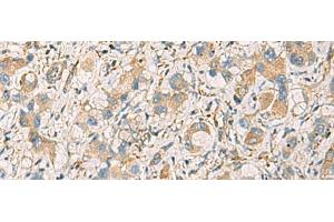 Immunohistochemistry of paraffin-embedded Human liver cancer tissue using GNAZ Polyclonal Antibody at dilution of 1:70(x200) (GNaZ anticorps)