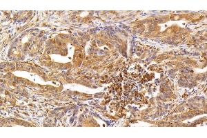 Detection of IL17 in Human Stomach cancer Tissue using Monoclonal Antibody to Interleukin 17 (IL17)