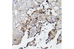 Immunohistochemistry of paraffin-embedded human lung cancer using Mucin 5AC (MUC5AC) antibody (ABIN7268694) at dilution of 1:50 (40x lens). (MUC5AC anticorps  (C-Term))