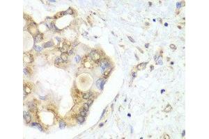 Immunohistochemistry of paraffin-embedded Human liver cancer using VTI1B Polyclonal Antibody at dilution of 1:100 (40x lens). (VTI1B anticorps)