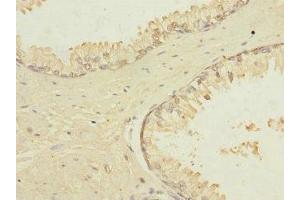 Immunohistochemistry of paraffin-embedded human prostate cancer using ABIN7172867 at dilution of 1:100 (TRPM4 anticorps  (AA 1-240))