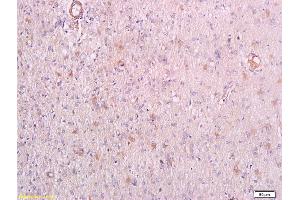 Formalin-fixed and paraffin embedded human endometrial carcinoma labeled with Anti-phospho-PRKCQ(Thr538) Polyclonal Antibody, Unconjugated (ABIN711746) at 1:200 followed by conjugation to the secondary antibody (PKC theta anticorps  (pThr538))
