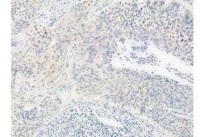 ABIN6261112 and ABIN6277999 at 1/100 staining human cervical carcinoma by IHC-P. (Cullin 4B anticorps  (N-Term))