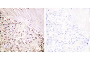 Peptide - +Immunohistochemical analysis of paraffin-embedded human breast carcinoma tissue using FANCD2 (Ab-222) antibody (#B0427). (FANCD2 anticorps  (Ser222))