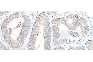 Immunohistochemistry of paraffin-embedded Human colorectal cancer tissue using GARNL3 Polyclonal Antibody at dilution of 1:100(x200) (GARNL3 anticorps)