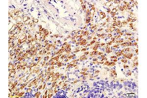 Formalin-fixed and paraffin embedded mouse tumor with labeled Anti-phospho-AKT/PKB(Ser473) Polyclonal Antibody, Unconjugated (ABIN729298) at 1:600, followed by conjugation to the secondary antibody and DAB staining (AKT 1/2/3 anticorps  (pSer473))