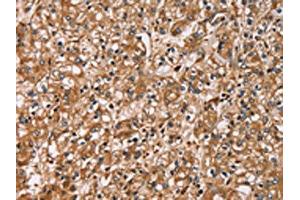 The image on the left is immunohistochemistry of paraffin-embedded Human prostate cancer tissue using ABIN7129785(HTR3C Antibody) at dilution 1/30, on the right is treated with fusion protein. (HTR3C anticorps)