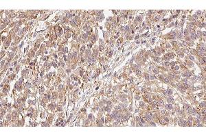 ABIN6279444 at 1/100 staining Human Melanoma tissue by IHC-P. (FGF9 anticorps  (N-Term))