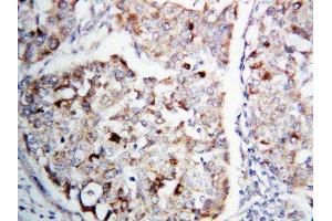 Anti-MEK1 antibody, IHC(P) IHC(P): Human Lung Cancer Tissue (MEK1 anticorps  (C-Term))