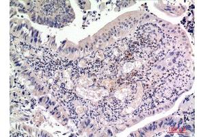 Immunohistochemistry (IHC) analysis of paraffin-embedded Human Colon Cancer, antibody was diluted at 1:100. (FGF2 anticorps  (Internal Region))